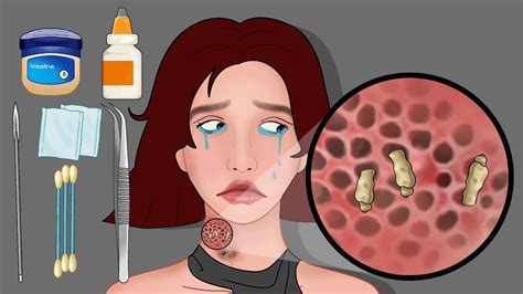 Asmr Animation Remove Worm And Neck Infected Severely Injured Animation