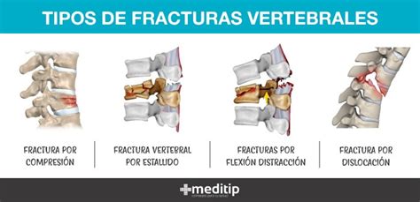 Fracturas Vertebrales Causas Diagnóstico Y Tratamiento Meditip