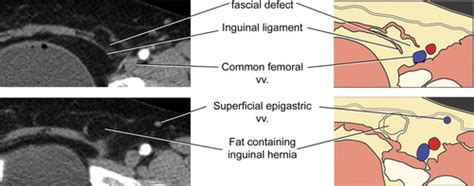 Femoral Canal Hernia