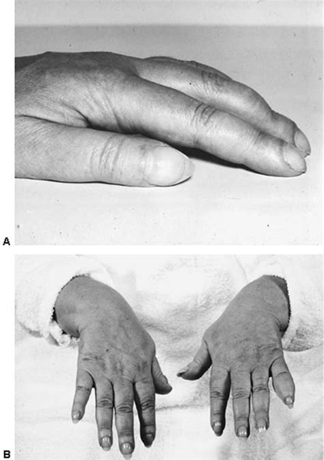 Localized Myxedema And Thyroid Acropachy Werner And Ingbars The