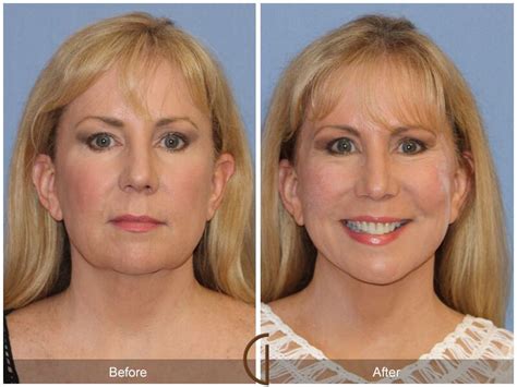 Facelift Fifties Before And After Photos From Dr Kevin Sadati