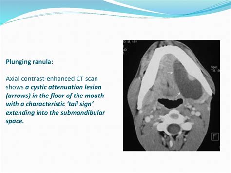 Cystic Masses Of Neck