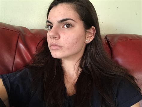 Fortify the fight against acne with acnetame vitamin supplements for oily skin, 60 natural pills. Best Vitamin C Serum For Hyperpigmentation Reddit ...