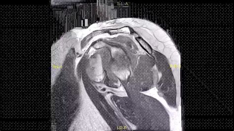 Lipoma Of The Shoulder Complete Mri Examination Youtube