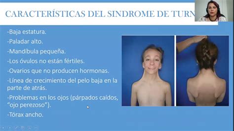 Sindrome De Turner YouTube