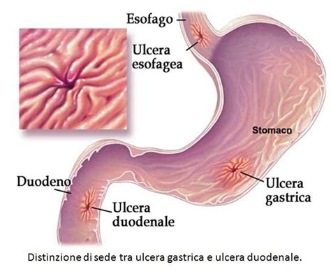 Ulcera Dello Stomaco E Del Duodeno Roma Dott Iannetti Gastroenterologo