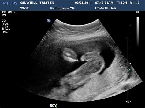 Inside Tristen 20 Week Ultrasound Its A Boy