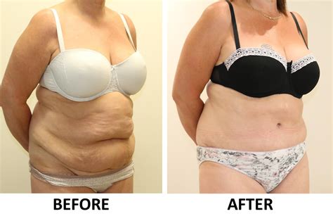 Tummy Tuck Abdominoplasty Before And After Photos SexiezPicz Web Porn