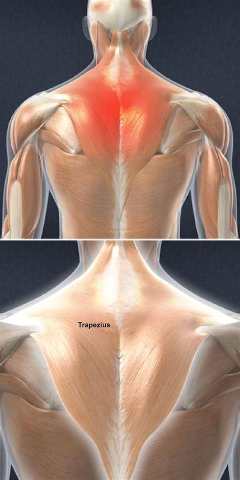 Muscle Strain Of The Upper Back Trapezius Strain