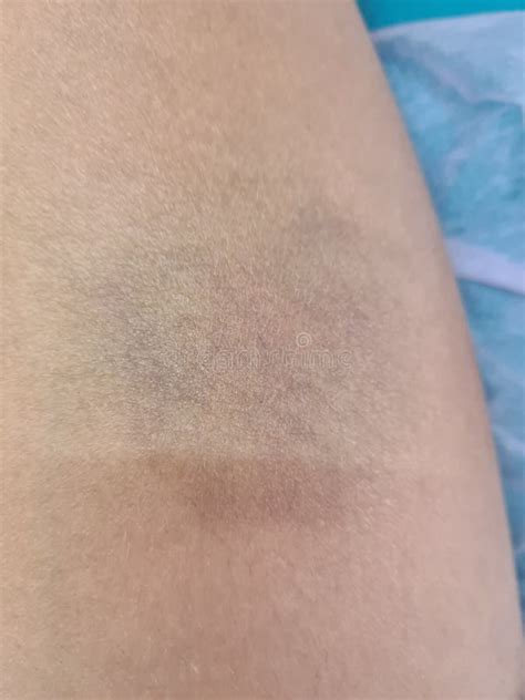 Closeup Of Bruise On Skin Of Injured Woman Leg Stock Image Image Of