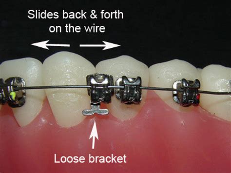 What To Do When You Have A Loose Dental Bracket News Dentagama