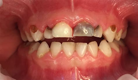 Cavities In Children
