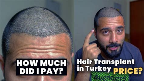 The Ultimate Guide To Fue Hair Transplants In Turkey Qunomedical