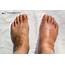 Swelling In Your Feet Or Ankles Should Never Be Ignored  Gentle Foot Care
