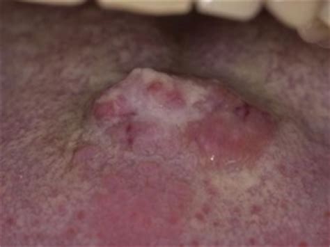 These are the questions which you can ask to rule out contraindications. Dentalnews (en) » Blog Archive » Symptoms of tongue cancer