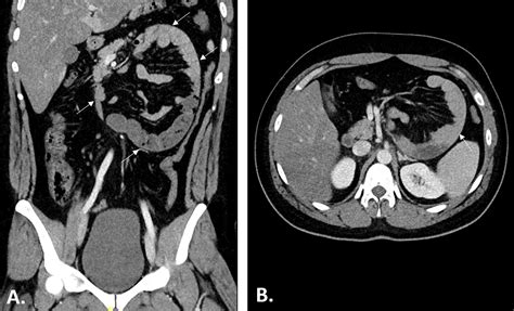 Cureus Left Paraduodenal Hernia Case Report Of Rare Cause Of