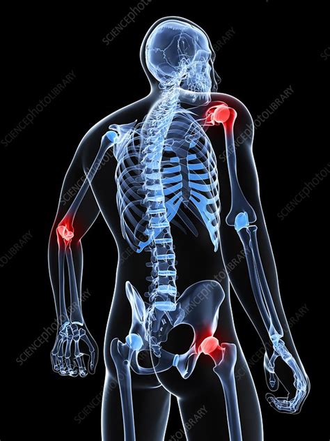 Joint Pain Conceptual Artwork Stock Image F0068057 Science