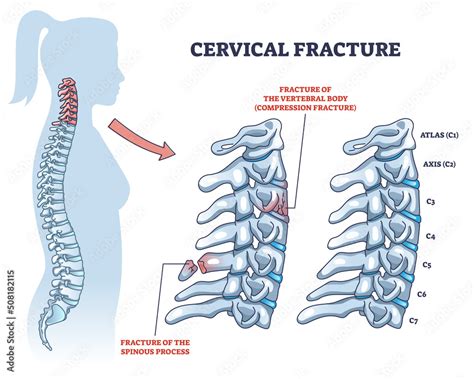 Cervical Fracture And Human Spine And Vertebrae Damage Outline Diagram