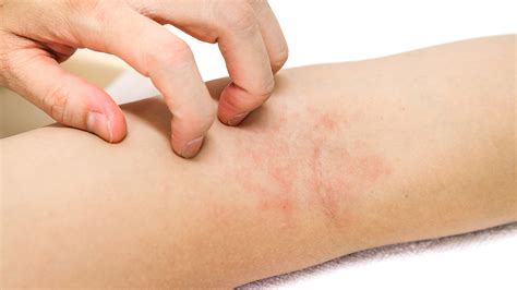 Soigner l eczéma ou la dermatite atopique par homéopathie Astuces Pharma