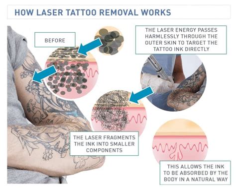Check spelling or type a new query. The Wheres, Whats and Hows of Tattoo Removal in Singapore
