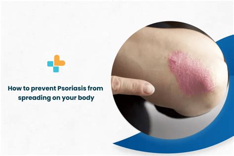 How To Prevent Psoriasis From Spreading On Your Body