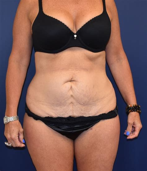 Jen shah is reportedly headed for a horrible outcome after being charged with fraud and money laundering earlier this year. Tummy Tuck Before and After Photos by Richard Reish, MD ...