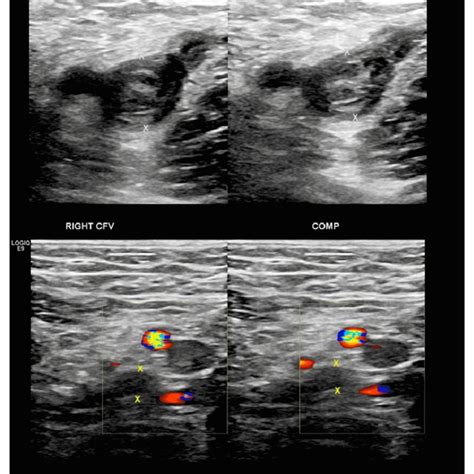 Right Lower Extremity Doppler Ultrasound Showing Extensive Occlusive Download Scientific