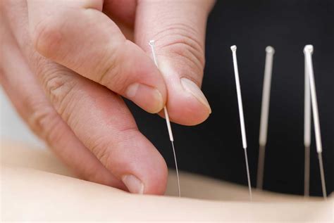 How Does Acupuncture Work To Relieve Pain Archives