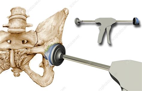 Hip Replacement Artwork Stock Image C009 7634 Science Photo Library