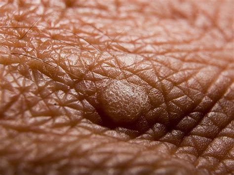 Types Of Warts Pictures Symptoms And Causes