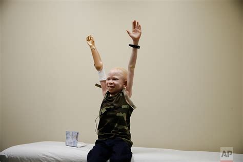Children With Albinism Mutilated In Tanzania Get New Limbs In Us — Ap