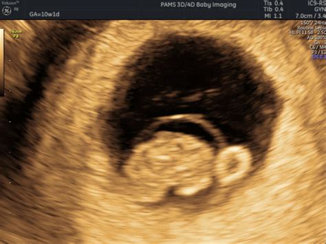 Early Pregnancy Scan Private One On One Pregnancy And Fertility
