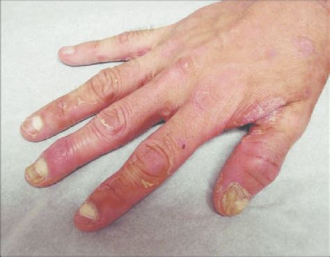 This Image Of The Dorsal Hands Of A 33 Year Old Man With Syphilis Shows