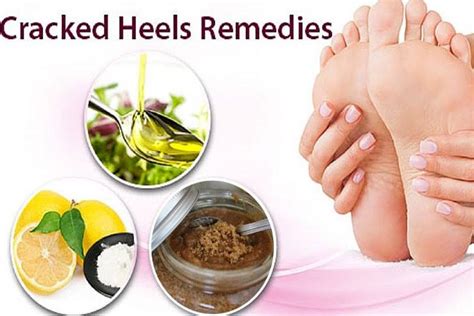 20 Natural Home Remedies To Cure Cracked Feet Heels Quickly