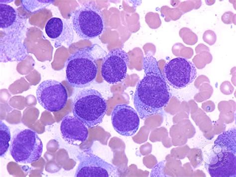 Acute Monocytic Leukemia 3