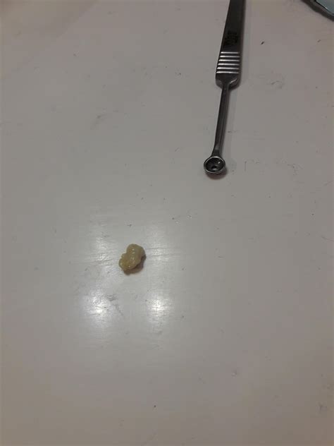Just Found Out Ive Got Tonsil Stones Do I Need To Get A Doctor