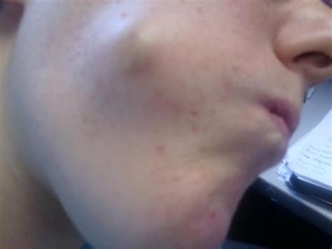 Sebaceous Cyst Help Pictures General Acne Discussion By
