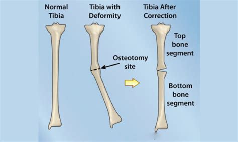 Deformity Correction Osteotomy Pune Foot Ankle