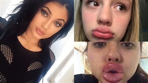 Kylie Jenner Challenge Leads To Teen Lip Plumping Disasters