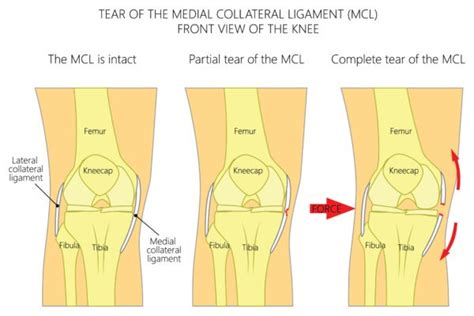 What Are Mcl And Lcl Sprain And Tears Symptoms Treatment