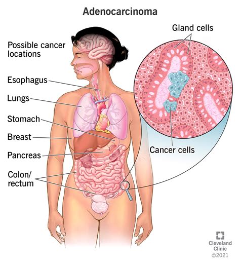 Carcinoma Types Treatment What It Is