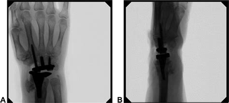 A Anteroposterior And B Lateral Views Of Total Wrist Arthroplasty