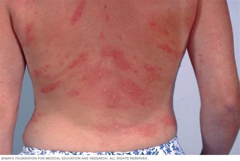 Hives On Light Skin Mayo Clinic