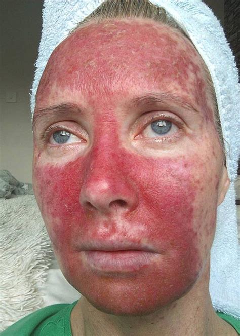 Red skin under and on the sides of your nose isn't usually a cause for concern, but it might indicate. Irish Mum Warns Of Tanning Dangers With Pre-Cancer ...