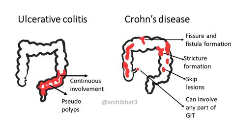 Pathology Of Ulcerative Colitis Pathology Made Simple