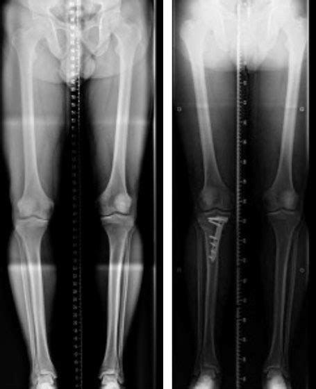 The Knee Clinic Knee Osteotomy The Knee Clinic