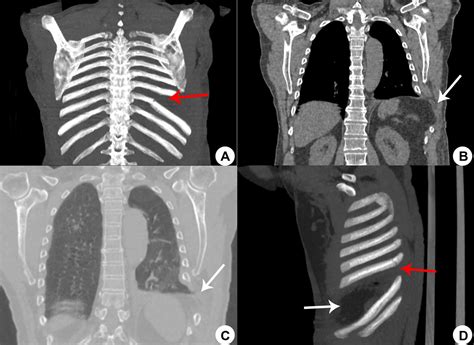 Cureus Clinical And Radiological Aspects Of Cough Induced Rib