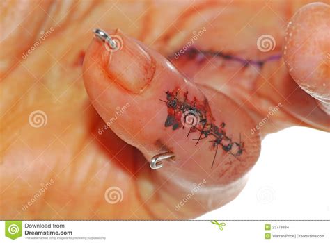 Surgical Pins Stock Photo Image Of Human Suture Surgical 23778834