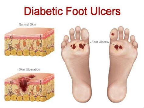 Pathophysiology Of Diabetic Foot Ulcer Ruth Wilson