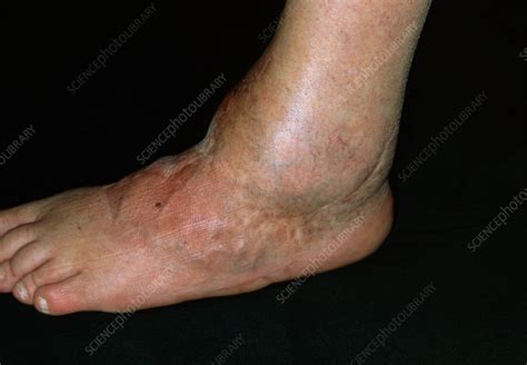 Arthritis Of The Ankle Stock Image M1100520 Science Photo Library